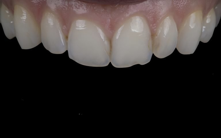 Situācija pirms zobu venīriem - nodiluši, trausli zobi. DrBite