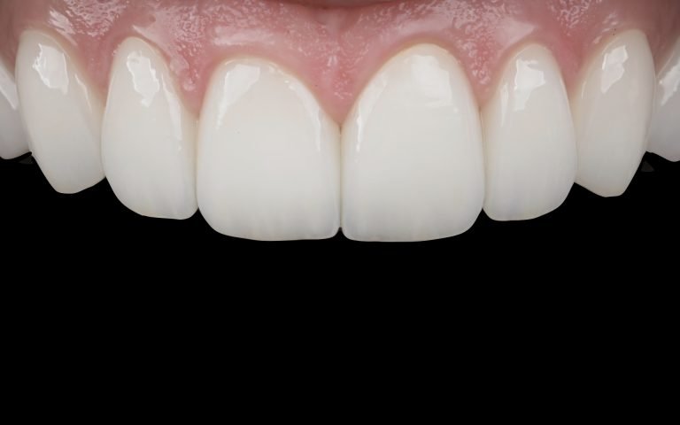 Mazinvazīvi, biomimētiski un gaiši venīri. DrBite