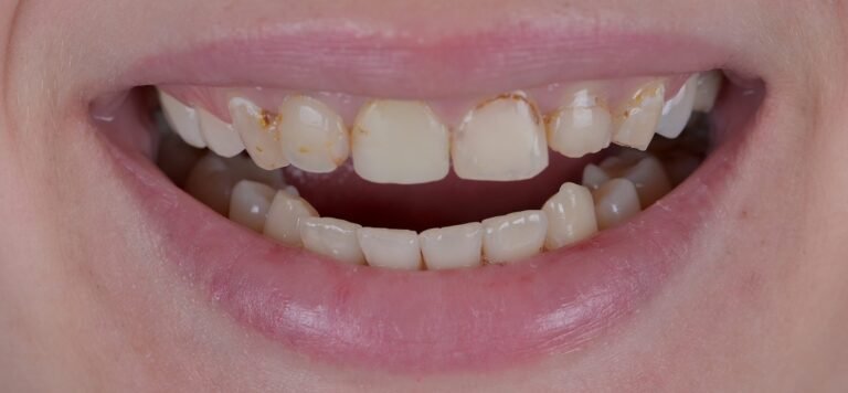 Pacienta smaids pirms procedūras ar bojātiem zobiem. DrBite