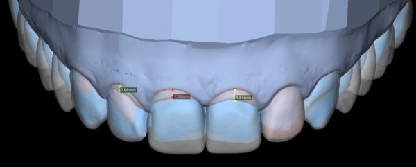 Smaganu plastikas plānojums
