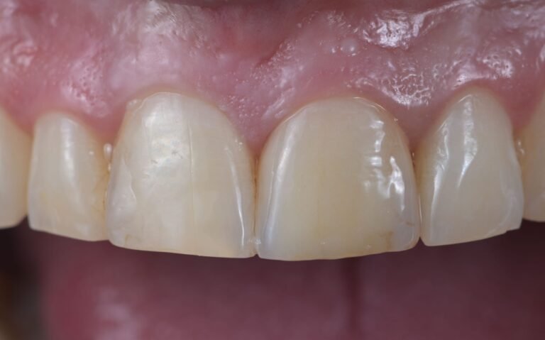 Lūzušajam zobam izveidojām keramikas kroni, kurš maksimāli līdzinās saviem zoba audiem