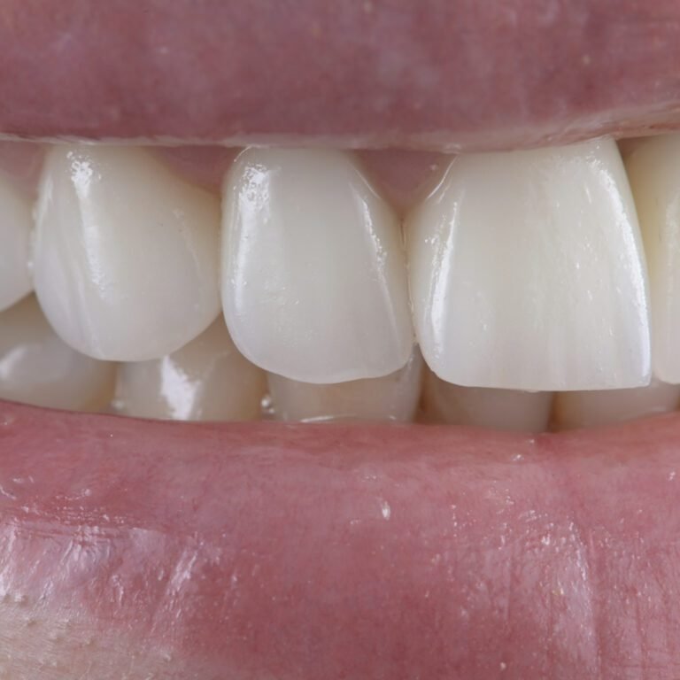 Zobu venīri, venīri - mazinvazīvi slīpētiem zobiem gaiši, dabīga izskata venīri