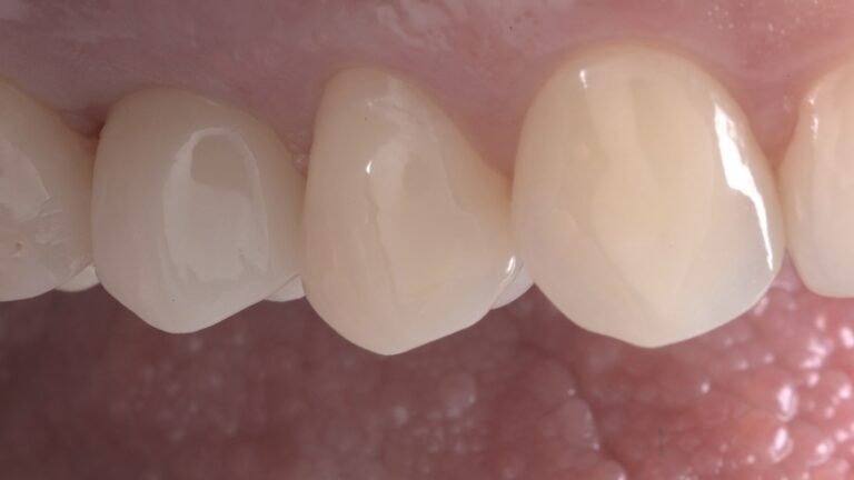 Sadzijis zobu implants pēc procedūras.